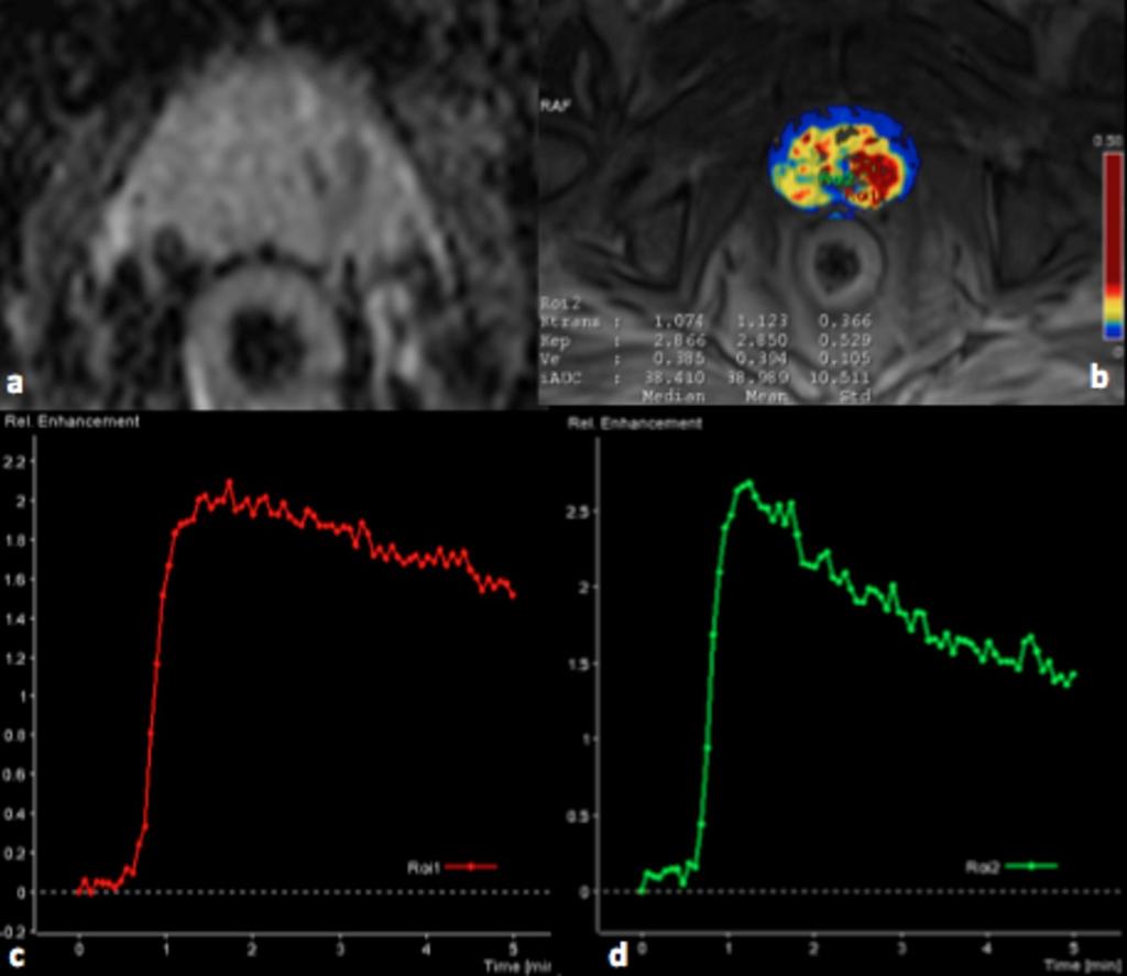 Fig. 13: 78-year-old patient with PSA level of 40 ng/ml and previously negative TRUS-guided biopsy. ADC map (a) shows restricted diffusion in the lesion with low mean ADC.
