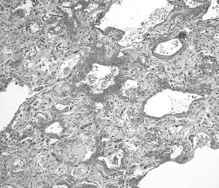Image 2 Diffuse alveolar damage with hyaline membranes superimposed on background fibrotic lung (H&E, 100).