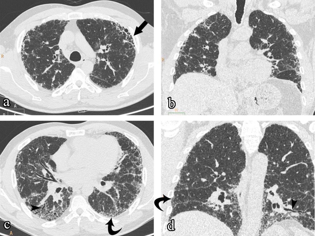 Fig. 1: Pattern of UIP: subpleural reticular opacities (curved arrows), traction bronchiectasis (arrowheads) and peripheral subpleural honeycombing