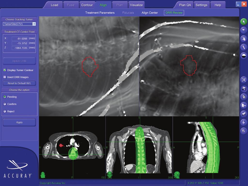 XSIGHT LUNG TRACKING SYSTEM Seamless integration of the Xsight Lung Tracking System into the MultiPlan Treatment Planning System demonstrating a contoured right upper lobe lung tumor.