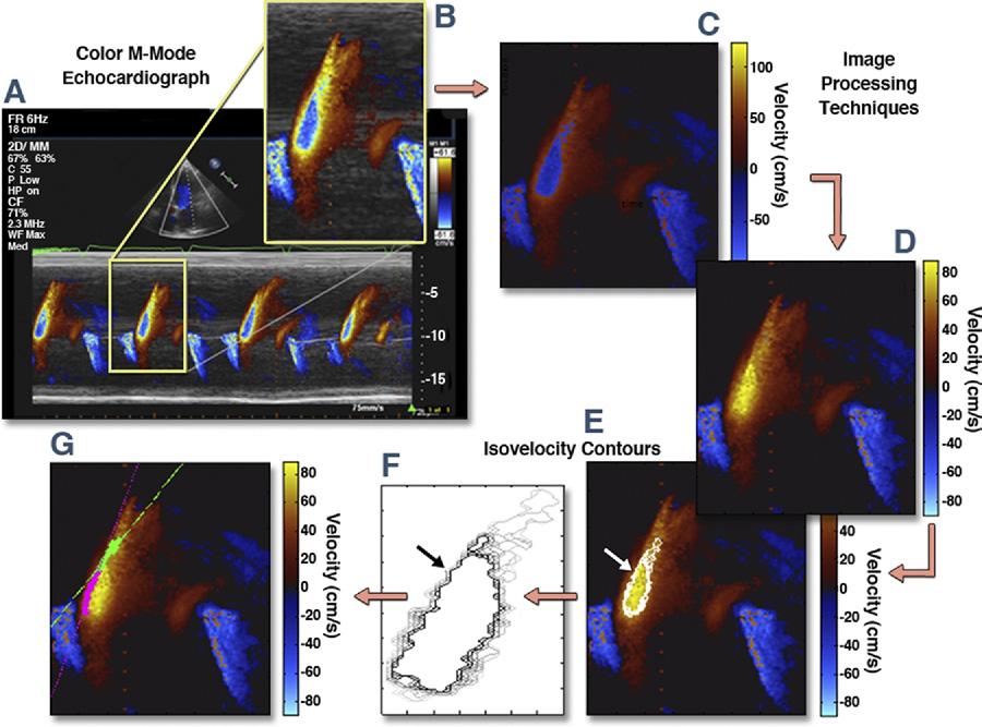 JACC: CARDIOVASCULAR IMAGING, VOL. 4, NO. 1, 2011 39 Figure 1. Color M-Mode Echocardiography Analysis Method Overview Color M-mode echocardiogram analysis of a restrictive filling patient.