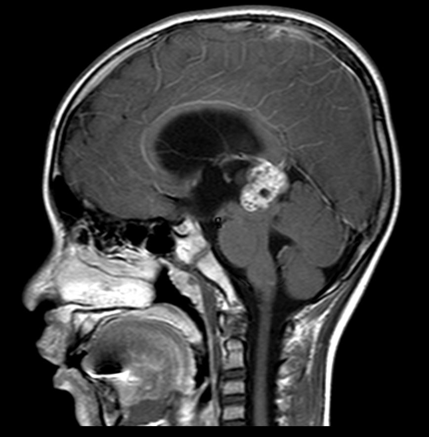 Differential Diagnosis: Pineal Region Tumor Germinoma Well defined with homogenous enhancement, isointense to gray matter Pineoblastoma Mixed Definitive diagnosis is signal on T1 and hyperintense on