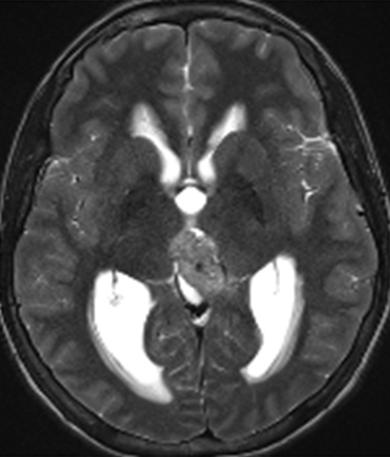 Treatment Pineal Region Tumors Manage hydrocephalus At time of biopsy or before Biopsy (incisional or excisional) surgical treatment is associated with high morbidity
