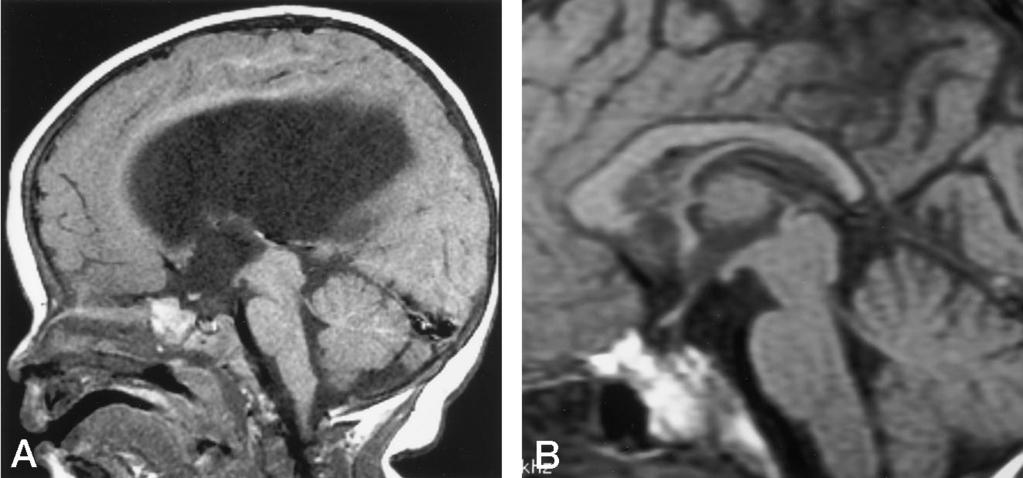 978 POUSSAINT AJNR: 19, May 1998 FIG 1. 7-month-old boy with hydrocephalus.