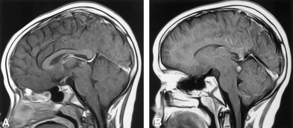 AJNR: 19, May 1998 TECTAL TUMORS 979 FIG 2. 8-year-old boy with diplopia and headache. A, Sagittal T1-weighted (600/15/1) MR image after contrast administration shows nonenhancing tectal mass.