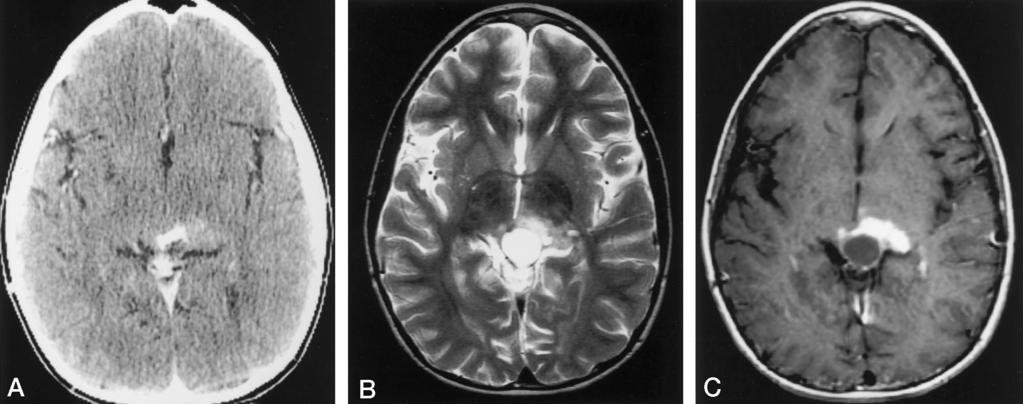 980 POUSSAINT AJNR: 19, May 1998 FIG 3. 9-year-old boy with headache, nausea, vomiting, mild ataxia, clumsiness, and intermittent diplopia.