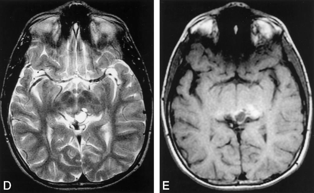 Axial T2-weighted (3550/103/2) (B) and axial T1-weighted (500/20/1) (C) MR images show increased T2 hyperintensity, enhancement, and cyst formation in tectal mass 10 months after stereotactic