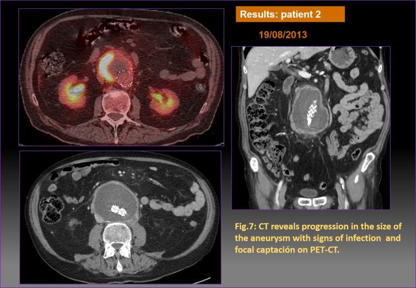 Patient 2: 80 year-old patient with hypertension, ischemic cardiomyopathy and smoking habits, is diagnosed of abdominal aortic aneurysm in April 2013 on CT performed in clinical context of back pain.