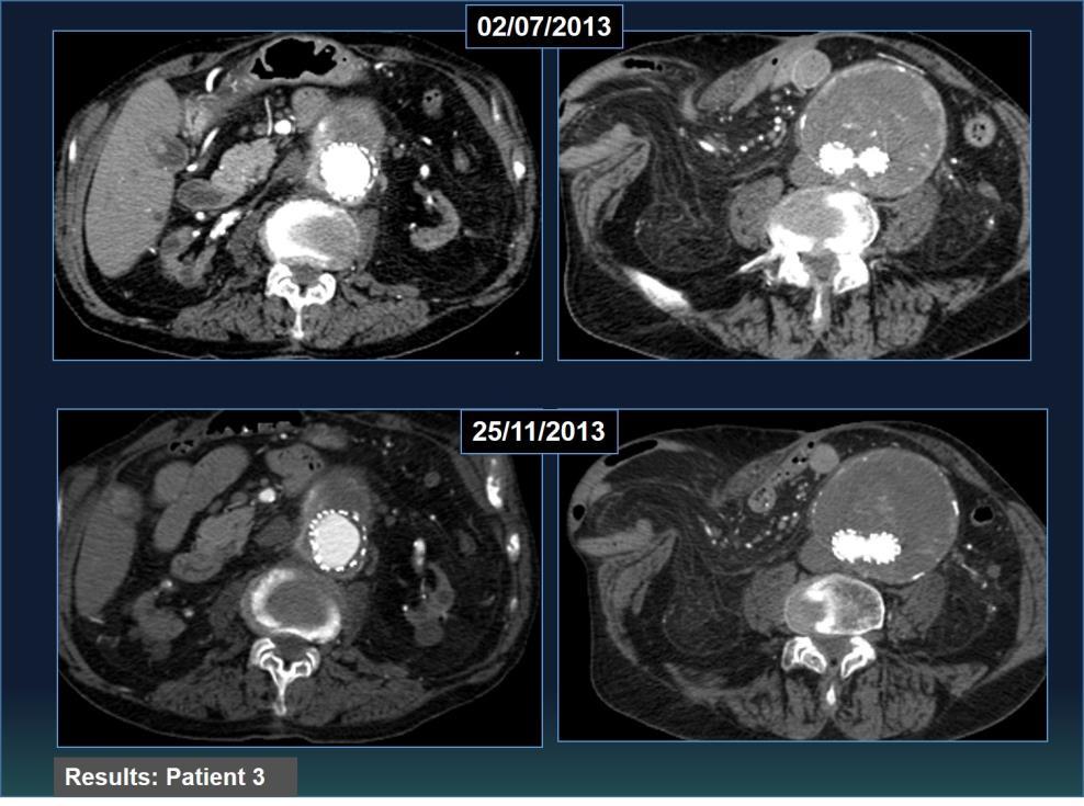 Patient 4: 71 year-old patient is admitted to hospital in 2010 because of epigastric pain and upper gastrointestinal