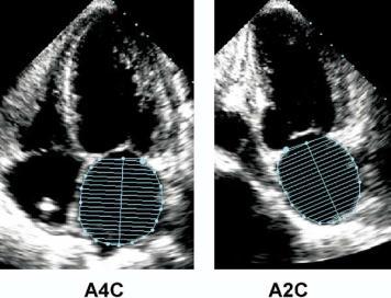 Left Atrial Volume Significant relationship to LA enlargement and diastolic function Measured in apical 4-chamber and two chamber views using area/length method Measure left atrial area Trace volume