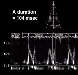 Mitral and P-Vein A duration comparisons AR Duration Optimize atrial reversal Doppler signal Requires sharp distinct signals Measure close to baseline Difference in durations must be > 30 msec