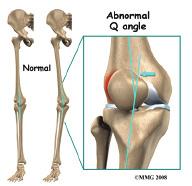 affected even those who do not participate in sports or recreational activities. There are extrinsic (outside) factors that are linked with overuse tendon injuries of the knee.