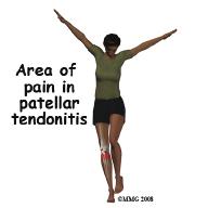 Pain from patellar tendonitis is felt just below the patella. The pain is most noticeable when you move your knee or try to kneel.