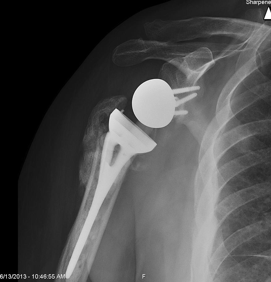 Conventional repair with a metal plate and screws may not work in certain cases where there is concern for the bone and rotator cuff tissue to heal.