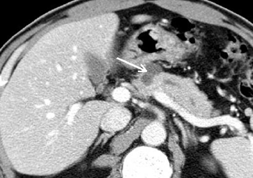 Fig. 2 Serous oligocystic adenoma of pancreas in 49-year-old man. Contrast-enhanced CT scan obtained during portal venous phase shows multicystic shaped cystic mass (arrow) in neck of pancreas.