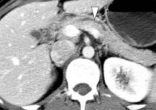 CT of Pancreatic Neoplasms Fig. 3 Serous oligocystic adenoma of pancreas in 34-year-old woman.