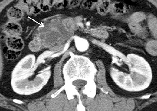 CT of Pancreatic Neoplasms illary mucinous tumor.