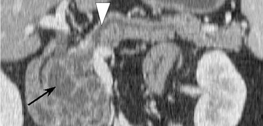 proximal MPD dilatation in serous oligocystic adenoma is probably a mass effect due to extrinsic compression [18, 21]. C Fig.