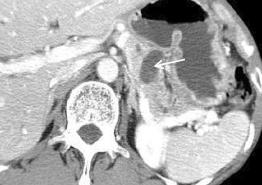 and B, Contrast-enhanced CT scans obtained during pancreatic () and portal venous (B) phases show grapelike cystic mass in head of
