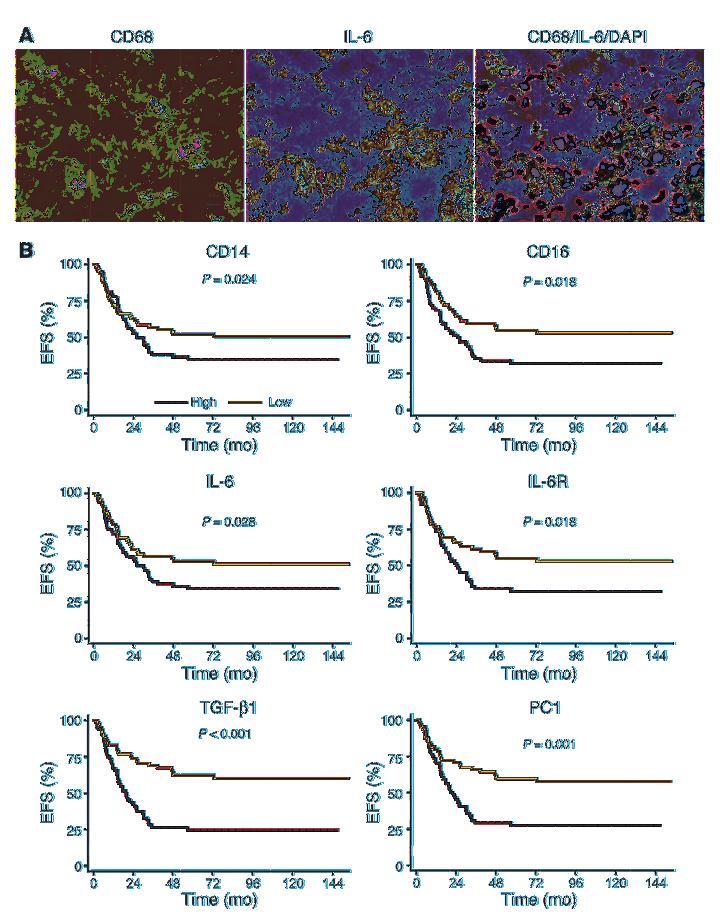 Figure 4 TAMs produce IL-6, and expression of TAM genes in primary tumors associates with poor outcome.