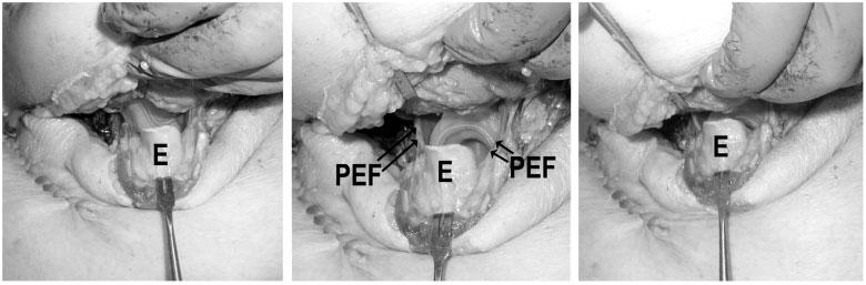 R. M. Levitan and W. C. Kinkle Æ I-gel airway Anaesthesia, 2005, 60, pages 1022 1026 Figure 2 Endoscopic images recorded upon exiting the tube section of the I-gel.