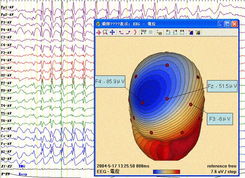 Neurology Asia June 2007 Fig.1 (a, b) SBS with stable one phase-reversal pattern at F4. See text. (Calibration: 40μV; 1 s). (a) (b) Fig.1: Stable SBS pattern with one phase-reversal.