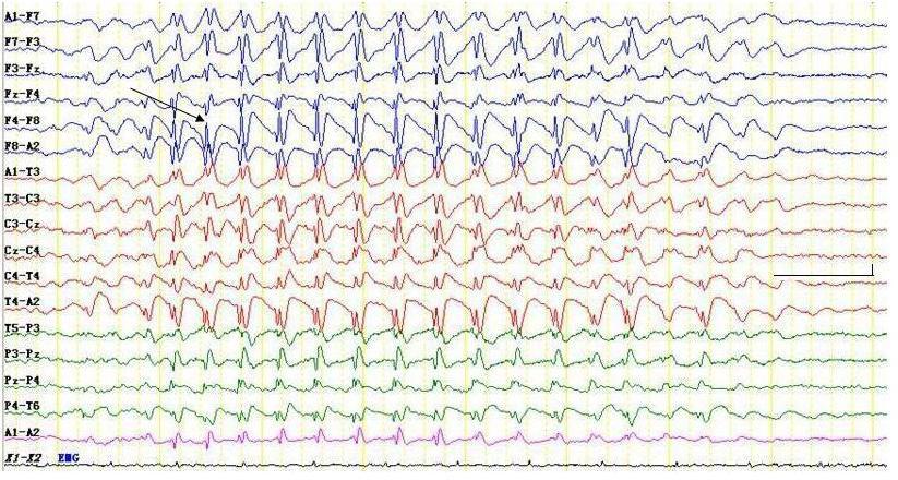 At the age of 24, she showed asymmetric tonic seizures of arms with head and eye aversion to the left side followed by generalized tonic-clonic seizures, which were documented by video-eeg monitoring.