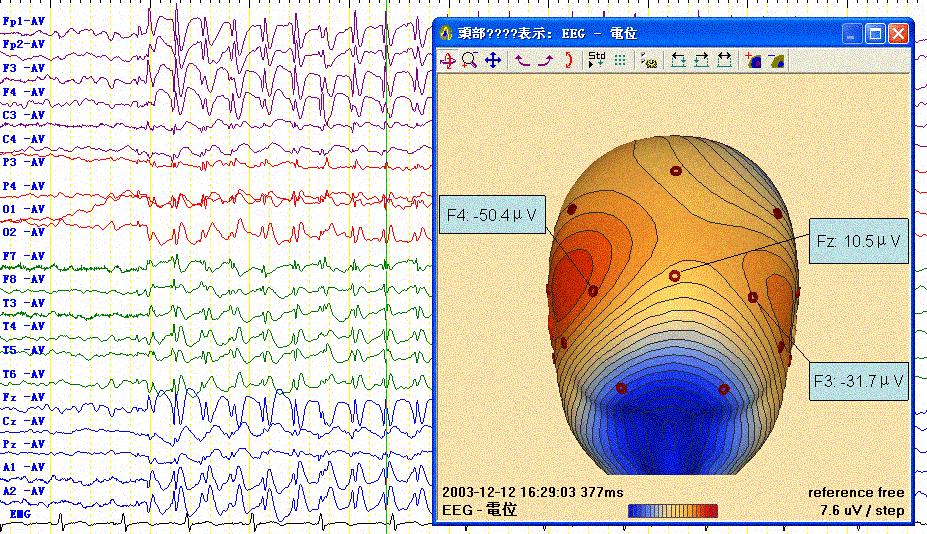 Neurology Asia June 2007 (c) Fig 2: Stable SBS pattern with a double phase-reversal.
