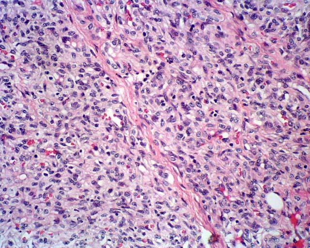 Benign Vascular Tumor Infantile Hemangioma Endothelial tumor VEF receptors LUT-1 positive Most common tumor of infancy 4% of