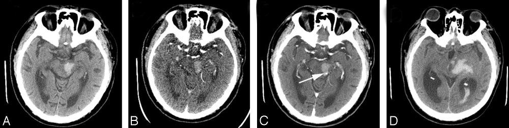 Fig 3. An 82-year-old man underwent imaging 0.5 hours following onset of right-sided weakness.
