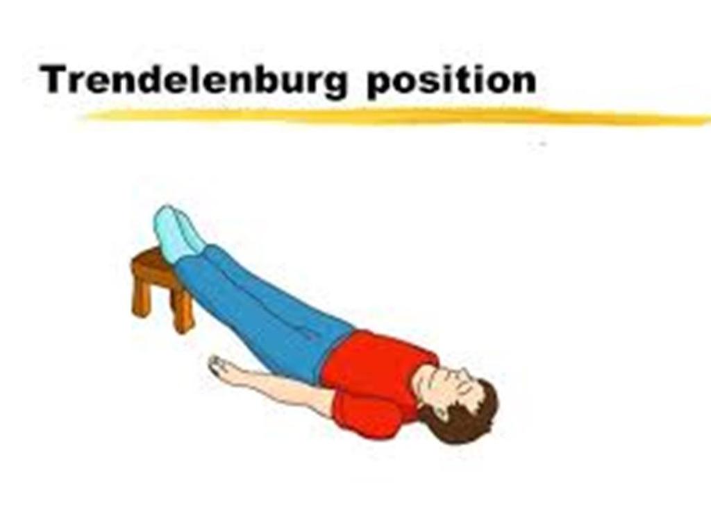 Management of shock: 1-Trendlenburg