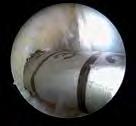 Oval Tunnel Technique This technical modification was based on the consideration that an oval tunnel more closely resembles the oval femoral ACL original zone than a round tunnel.