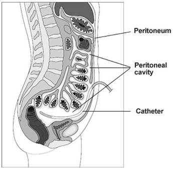 Continuous Ambulatory Peritoneal Dialysis (CAPD) Uses the peritoneal membrane for exchange of fluid and