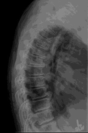 72 year old woman with 6 weeks of progressively worsening thoracic pain Seen at Emergency room 3 weeks ago Physical exam