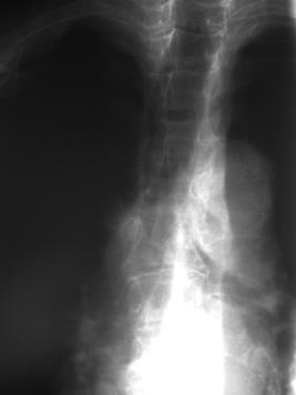 Diffuse pain in the thoracic spine A mild kyphosis in the