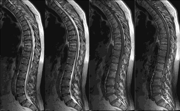Findings are consistent with longstanding seronegative spondyloarthropathy.