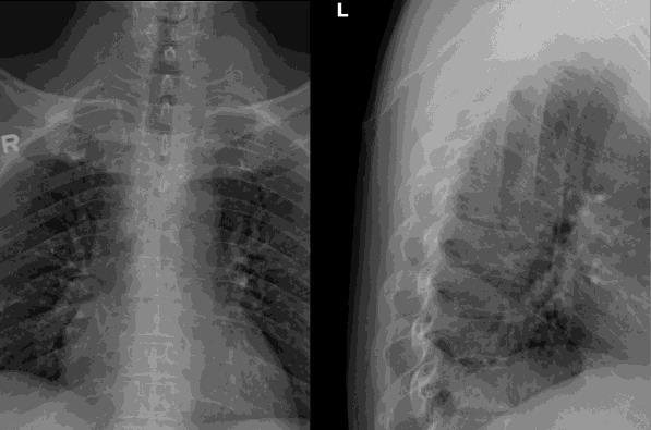 X-ray 1 month after onset of symptoms Mild anterior wedged deformity of T5 vertebral body with indistinct cortical borders of the pedicles and inferior endplate.