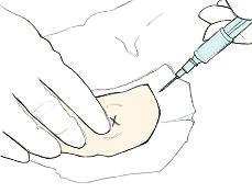 Patient Awareness How is an arterial catheter introduced at the