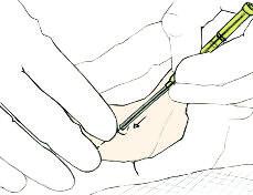 The interventional radiologist injects local anaesthetic in the