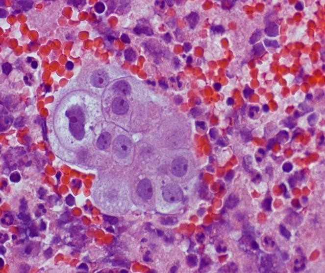cell carcinoma or a serous or