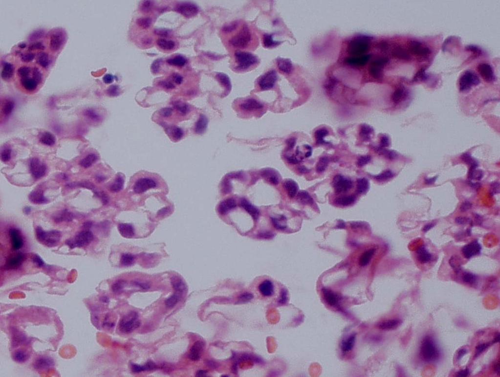 Cytologic features of OEC Malignant cells with vacuoles or a hint of clear