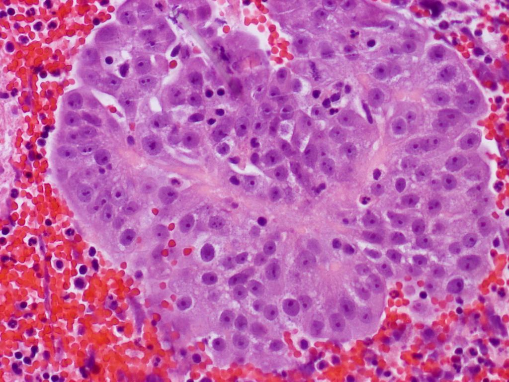 Cytologic features of OEC The presence of prominent
