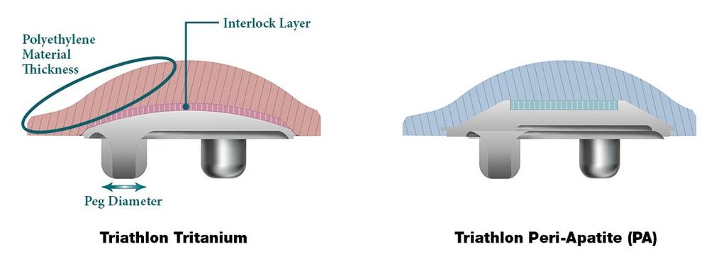 Triathlon Tritanium Knee System Metal-Backed Patella The Triathlon Tritanium metal-backed patella offers a highly porous biologic fixation surface in a monoblock design.