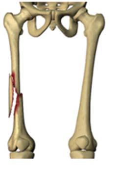 ICD 9 vs. ICD 10 Femur Fracture ICD 9 821.11 Open fracture of shaft of femur 16 ICD 9 codes for femur fracture ICD 10 S72.