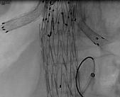 Adjuncts Preserve collateral spinal cord perfusion Carotid subclavian bypass Hypogastric artery