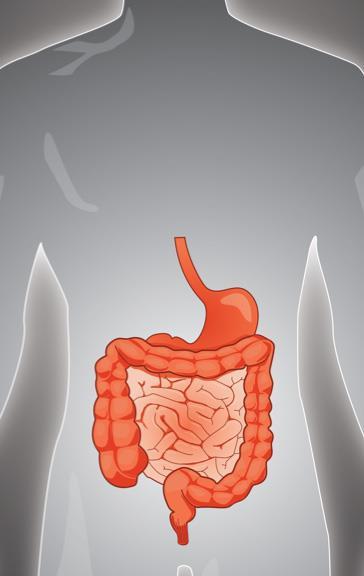ZP1848 for Short Bowel Syndrome (SBS) - A growing disease area of high unmet medical needs A malabsorption disorder caused by the surgical removal of the intestine Loss of functional intestine