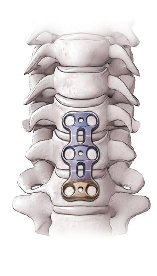 NOTE: Bone spurs should be removed from the end plates to create a smooth surface so the plate fits flush on the spine.