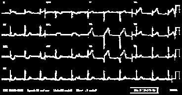 She did not take either her β-blocker or ACE-I this morning (she worries about getting light-headed while playing tennis) Patient #2 EKG reveals acute ST-T wave changes Troponin is elevated BP