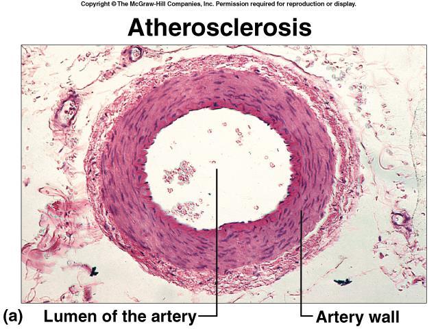 Heart Disease Cancer Stroke Hypertension Diabetes Arthritis Osteoporosis Obesity