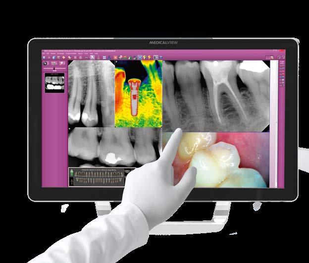 Designed to give easy access to distal zones, the C-U2 is thin and has a partially retroflexed 90 viewing angle.